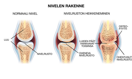 NIVELRIKKO