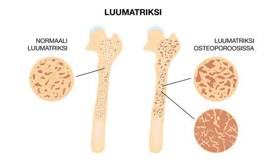 OSTEOPOROOSI